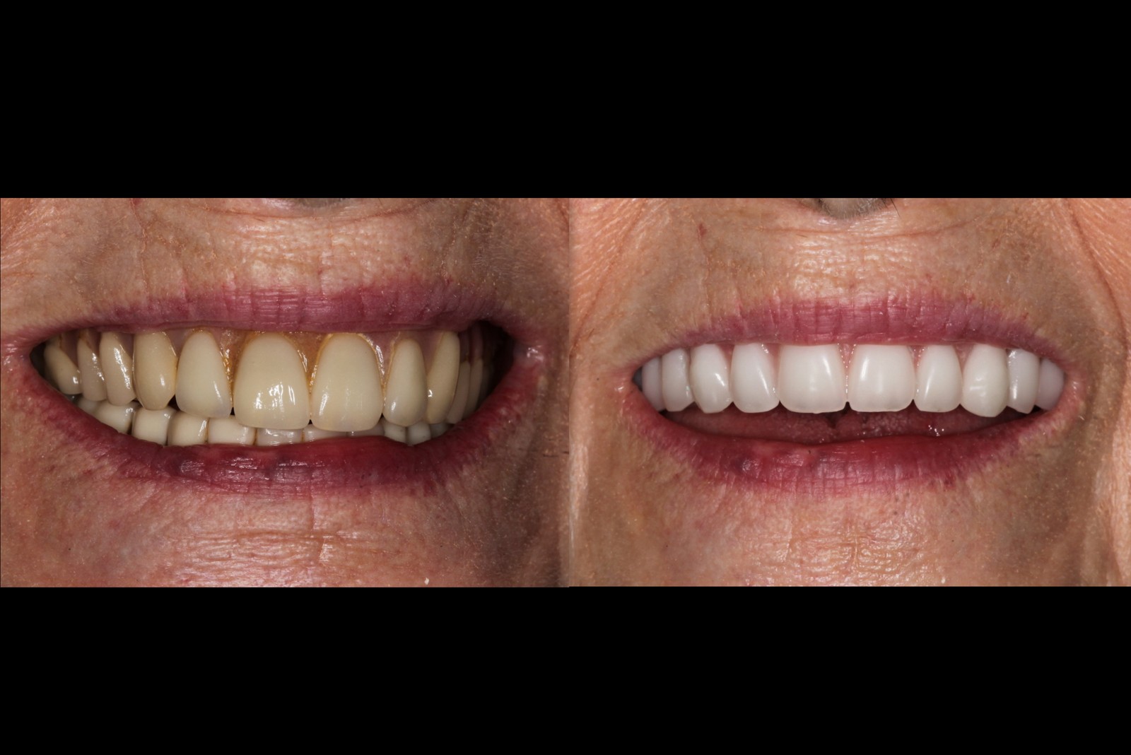 Before After Dentures