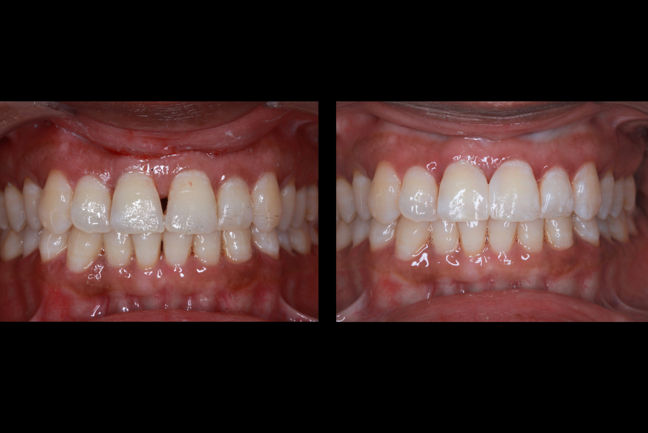 Before After Cosmetic Bonding