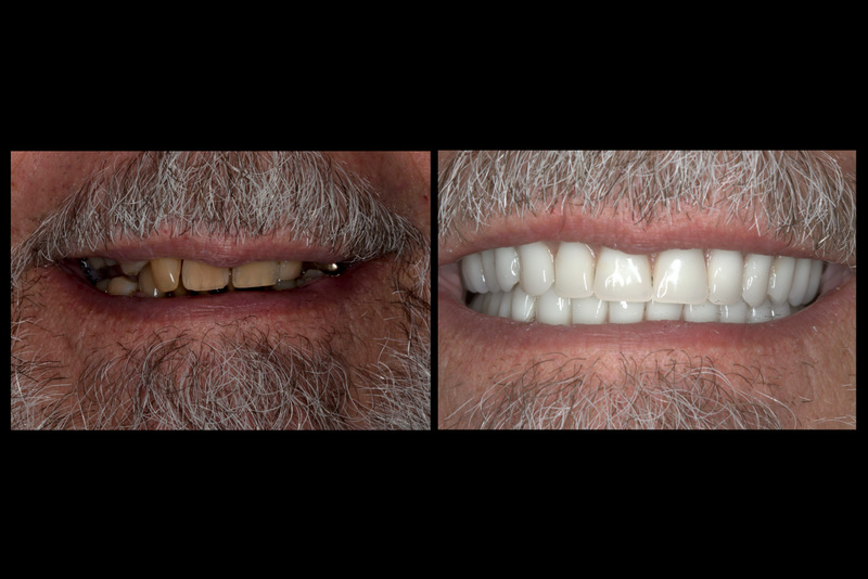 Before After Immediate Dentures