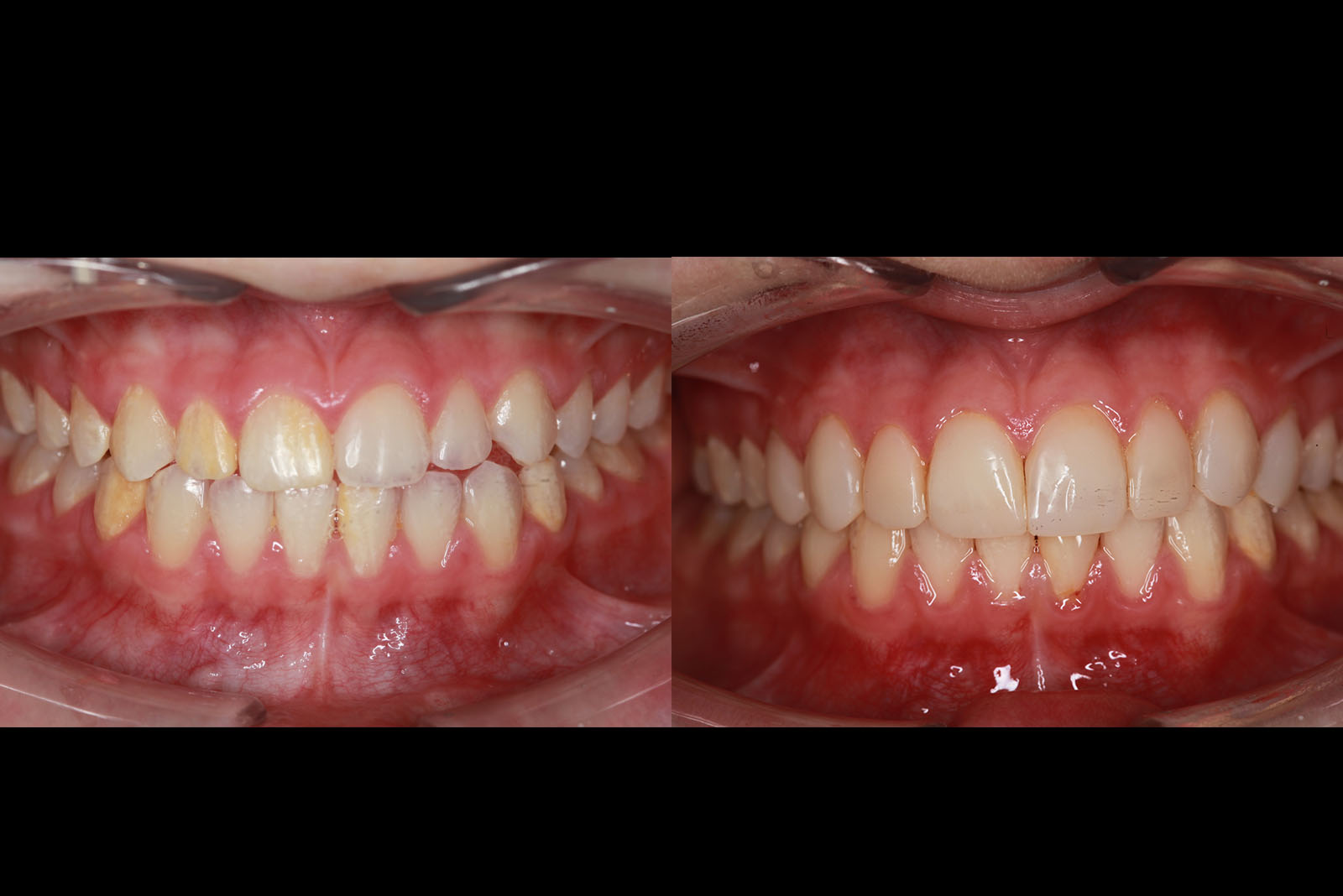Before After Composite Veneers