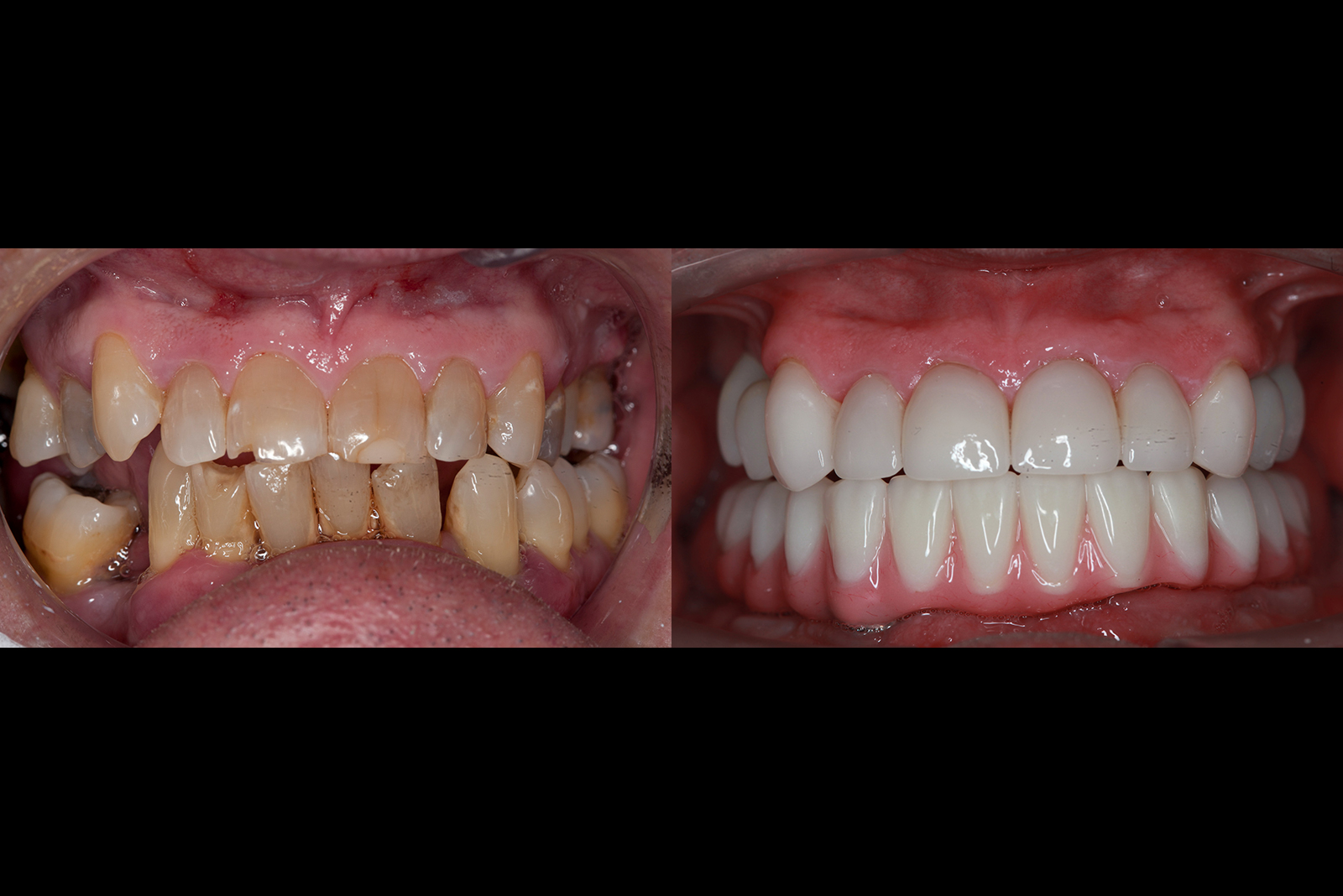 Before After Dentures and Implants