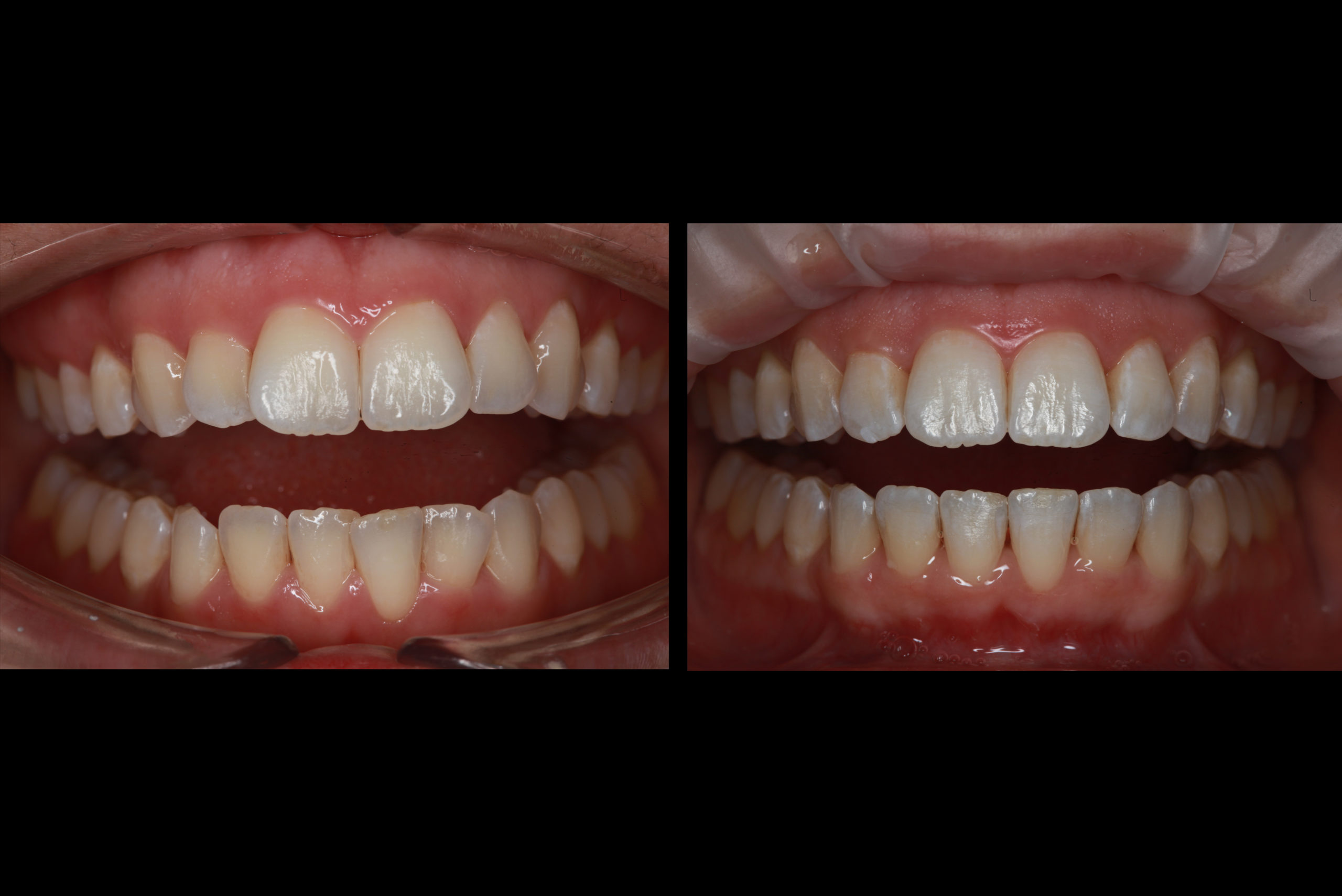 Before After SureSmile Aligners