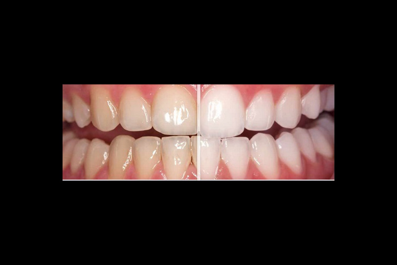Before After Teeth Whitening