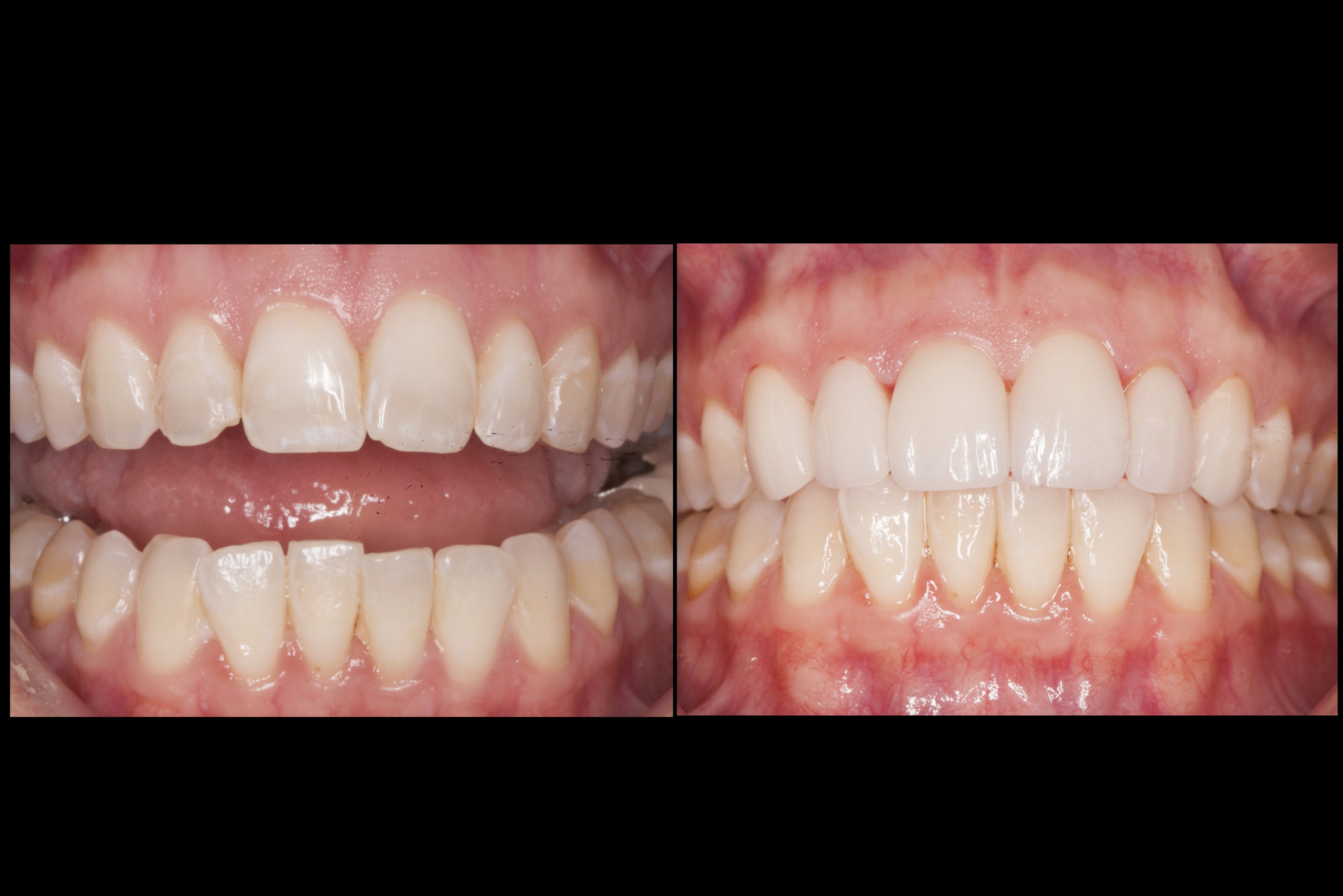 Before After Veneers