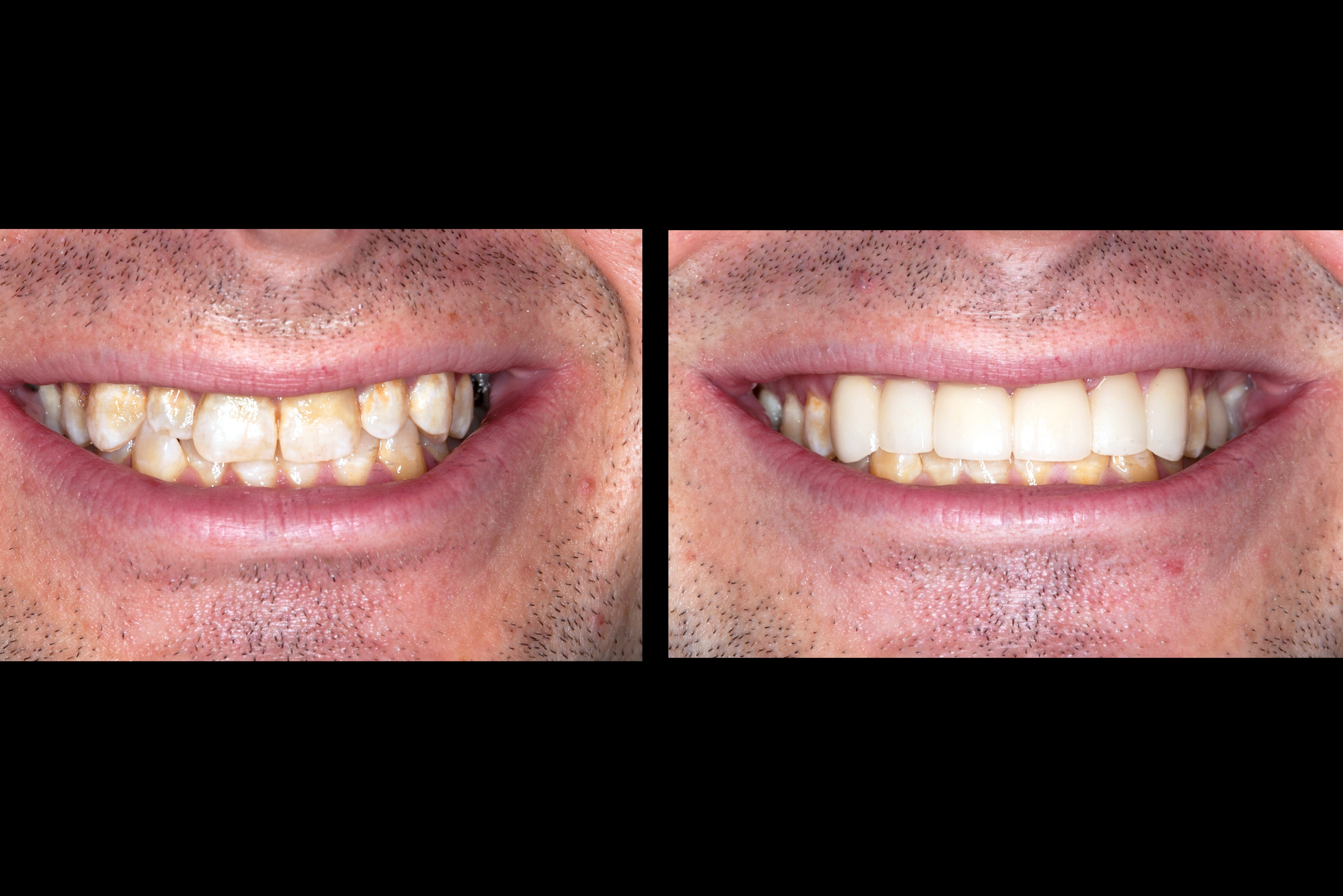 Before After Veneers