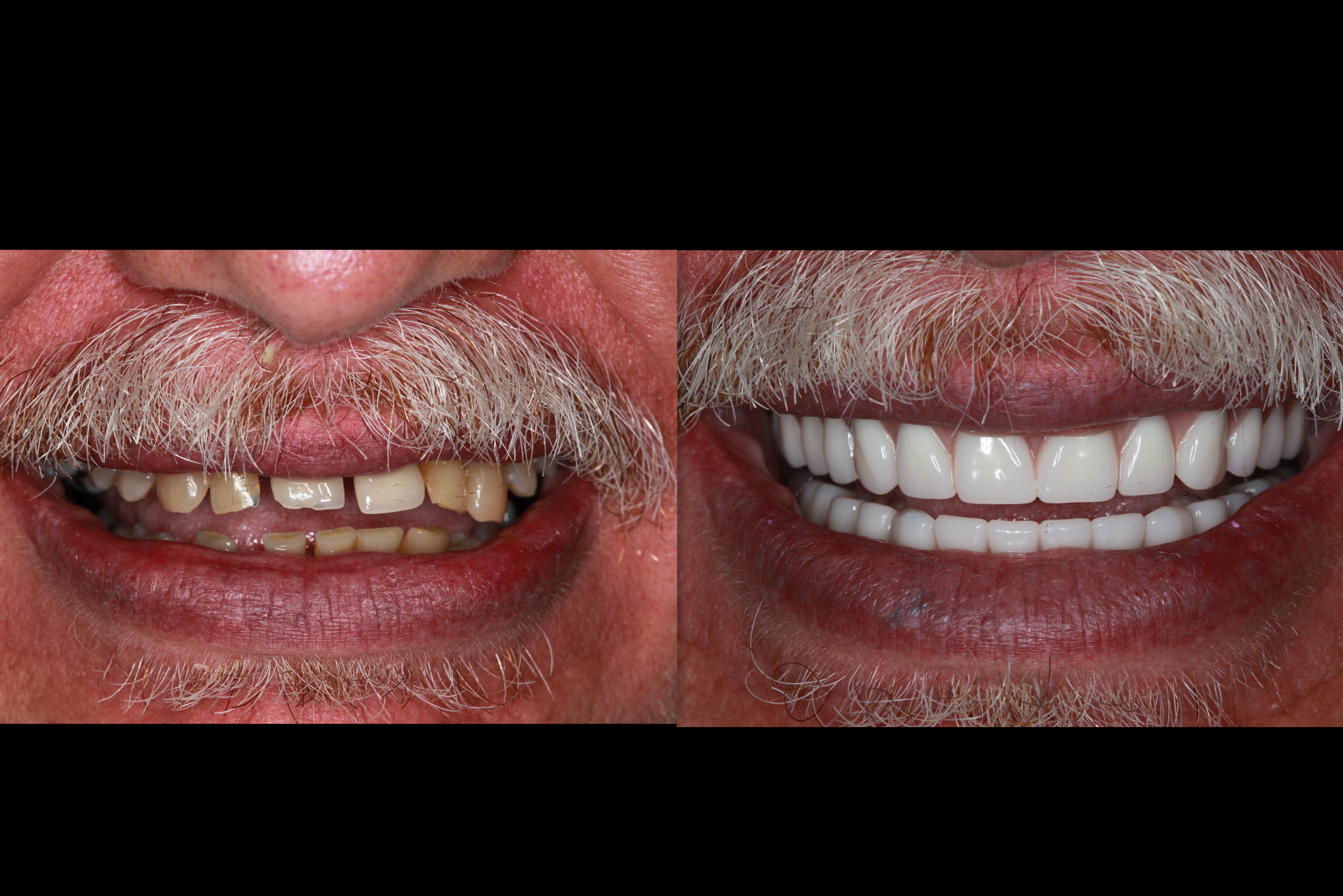 Before After Implant Dentures