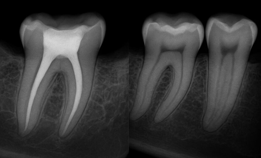 Root Canal Therapy